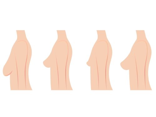 Illustrazione tipologie di seno